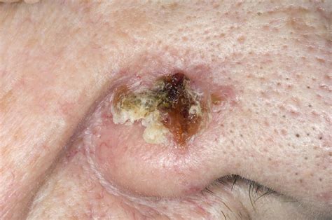 Skin Cancer On The Nose Stock Image C0041259 Science Photo Library
