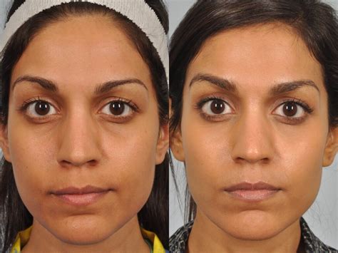 Tear Trough Filler Before And After W Cosmetic Surgery