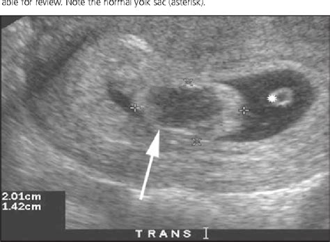 Figure 5 From The Chorionic Bump A First Trimester Pregnancy