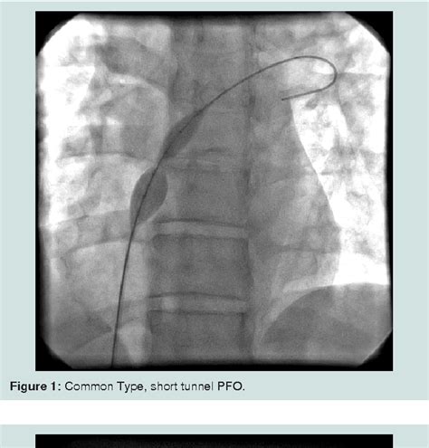Figure 1 From Outcome Of Percutaneous Patent Foramen Ovale Closure With