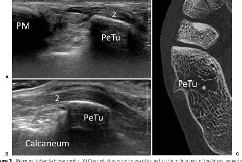 Figure 3 From Ultrasound Of Peroneal Tendons Semantic Scholar