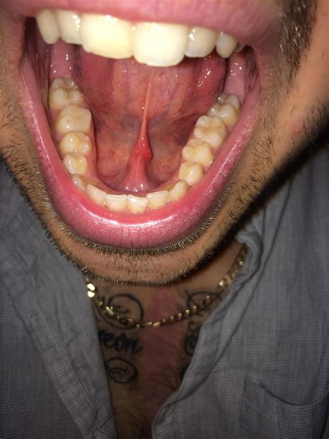 Lump under my tongue, on the frenulum?! Red, painful. Seeing a DR this ...