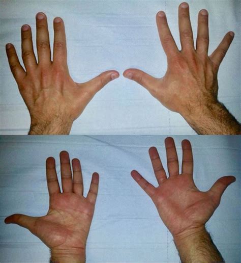 Ulnar Nerve Palsy Signs Porn Sex Picture