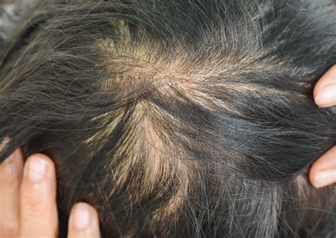 What Are The First Signs Of Balding And How It Can Be Cured Baggout