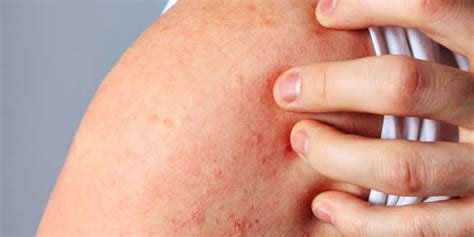 Dermatitis Causas Tipos Y Tratamiento Afecciónes De Piel