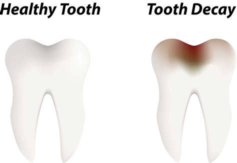 Cavities, also called tooth decay, are permanently damaged areas in the hard surface of your teeth that develop into cavities are caused by tooth decay — a process that occurs over time. Tooth Decay - Riverside Dental