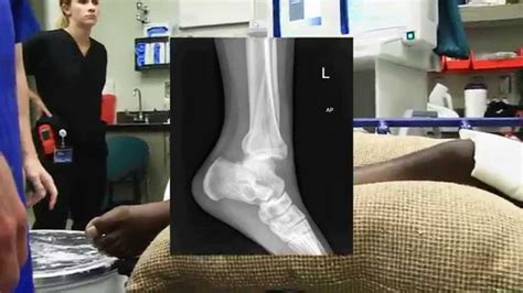 Ankle Fracture Dislocation Reduction Youtube
