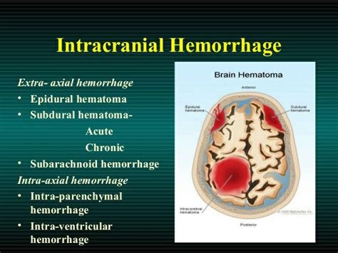 Brain Hemorrhages Subarachnoid Hemorrhage Subdural Hematoma