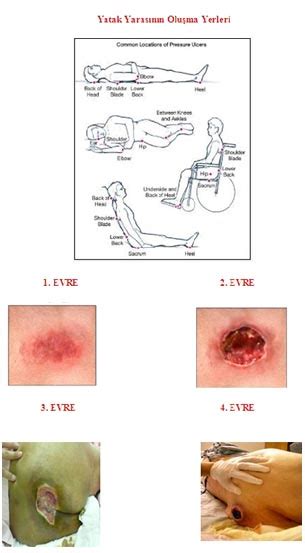 Bedsore Stages Photos Bruin Blog