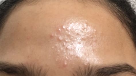 Clear Tiny Forehead Bumps Skin Bumps Forehead Acne Pi