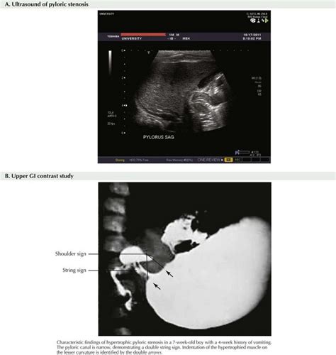 Pyloric Stenosis Pediatric Imaging