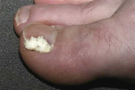 Toenail Fungus Pictures Causes Symptoms Get Rid Cure