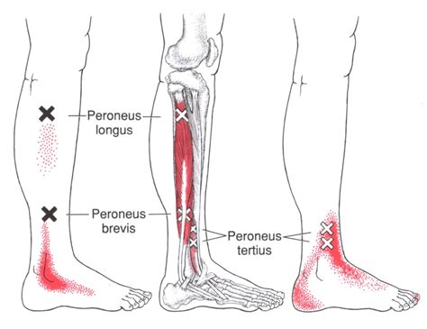 Peroneus Longus The Trigger Point And Referred Pain Guide