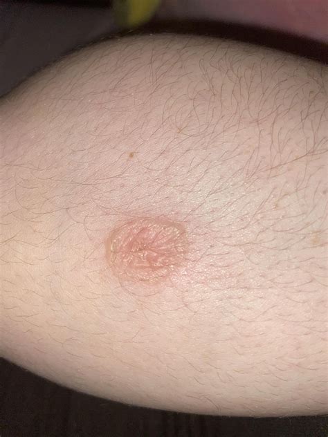 Ringworm Or Early Stage Psoriasis Raskdocs