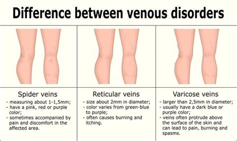 Get Rid Of Varicose Veins The Natural Way Herbs And Oils That Work