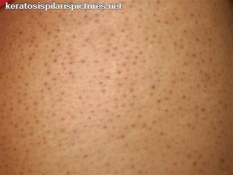 Keratosis Pilaris How To Get Rid Of The Dark Pores Poreminimizer