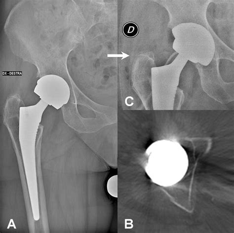 Subtle Rarefaction Around The Acetabular Prosthetic Component Ct Is