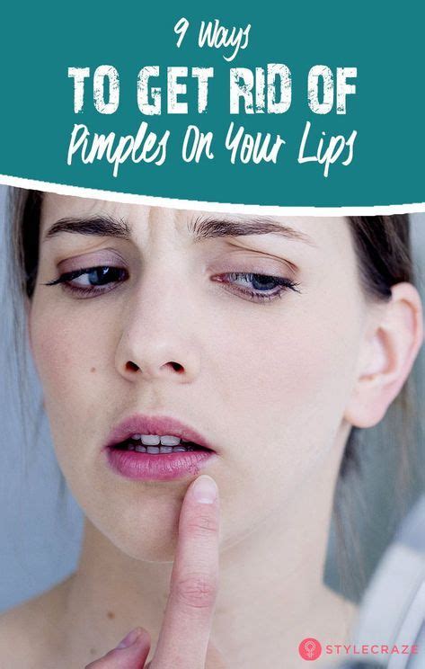 Cold Sores Vs Pimples How They Look Causes And Treatment How To Get
