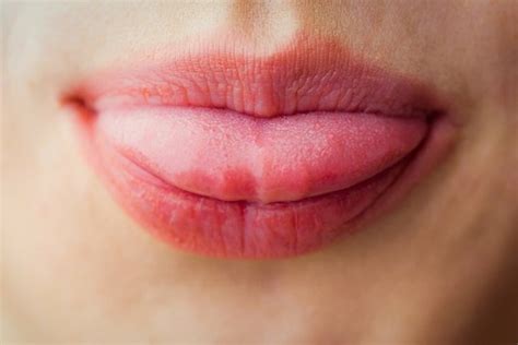 Herpes On The Tongue What It Is And How To Treat It