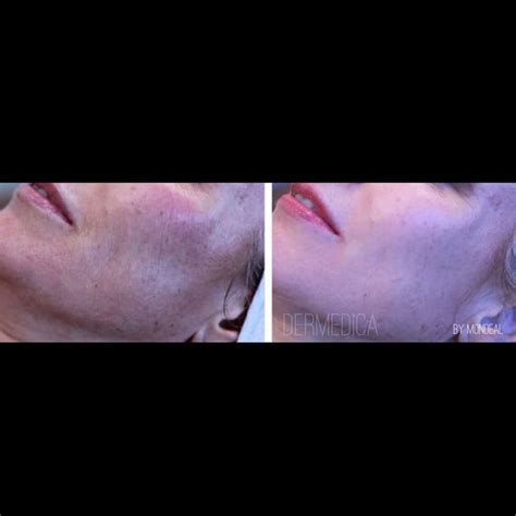 Collagen Stimulating Treatments Dermedica