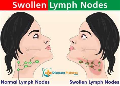 Swollen Lymph Nodes What Are The Causes Images And Photos Finder