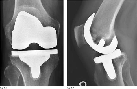 Figure 2 From Cemented Versus Cementless Total Knee Arthroplasty Of The
