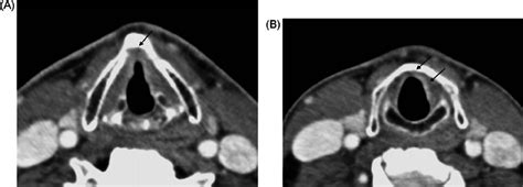 Glottic Cancer With Invasion Of The Anterior Commisure And Subglottis