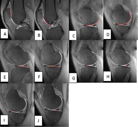 Quantitative Evaluation Of Knee Cartilage And Meniscus Destruction In