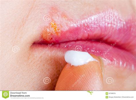 Herpes On The Lip Close Up Macro Woman Lubricates The Labial Herpes