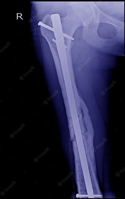 Premium Photo Fractured Femur Broken Leg X Rays Imagex Ray Image Of