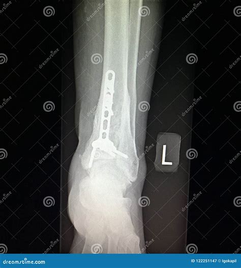 Ankle Left Tibia Distal Fracture Treatment Xray Stock Image Image Of