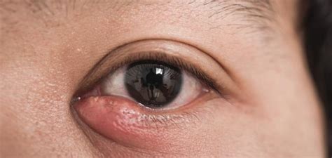 Bacterial Infection In The Eye