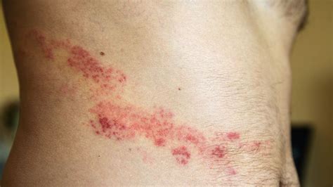 What Are The Early Symptoms Of Shingles Mira