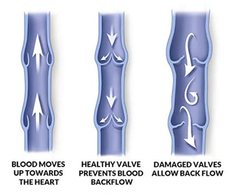 A Closer Look At Vein Complications Rupture And Bleeding Chuback Blog