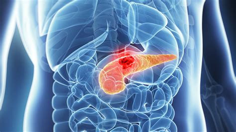 It helps you digest your food and makes hormones, such as insulin. Australian Researchers Find Pancreatic Cancer Is Four ...