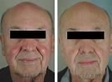Laser Treatments For Rosacea On Face Pictures