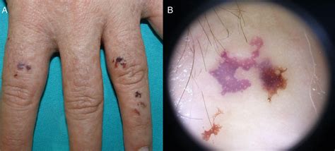 A Hemorrhagic Papules And Vesicles On The Dorsum Of The Fingers Case