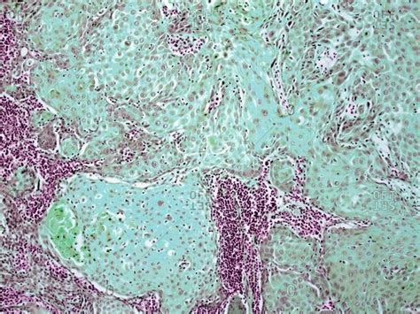 Light Micrograph Of A Section Through A Squamous Cell Carcinoma Of The