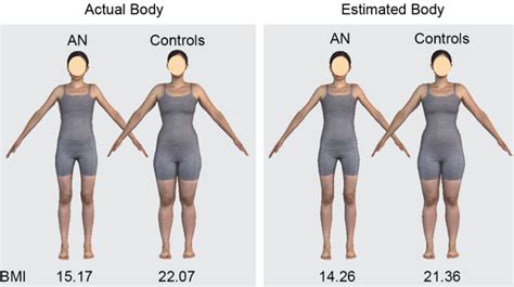 Assessing Body Image In Anorexia Nervosa Using Biometric Self Avatars