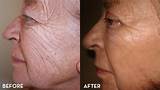 Laser Eye Wrinkle Treatment Cost Pictures