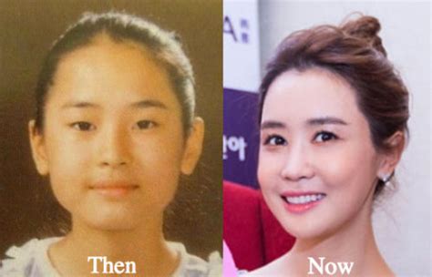 lee da hae plastic surgery before and after photos latest plastic surgery gossip and news