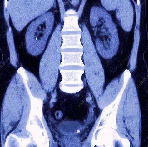 Kidney Stone Mri Scan Stock Image M1950185 Science Photo Library