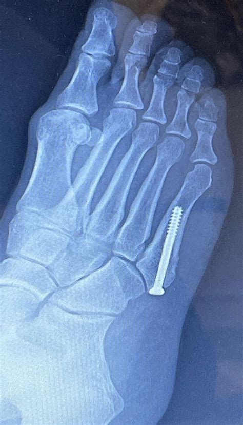 Jones Fracture Colorado Foot And Ankle Wellness