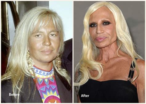 Donatella Versace Plastic Surgery Before And After Photo