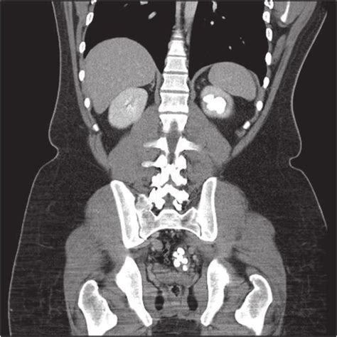 Ct Scan Of Abdomen Showing Multiple Stones In The Left Kidney And Lower