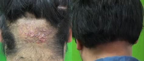 Back Of Head Razor Bumps Akn Dermhair Clinic 310 318 1500