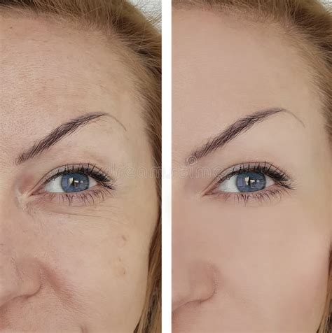 Face Woman Wrinkles Eye Before And After Correction Treatment