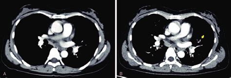 Chest Enhanced Ct Images A Before Pembrolizumab Administration B
