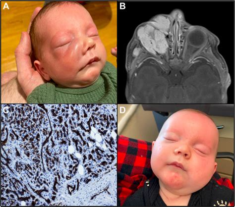 Unusual Deep Infantile Hemangioma Presentation With Orbital Involvement