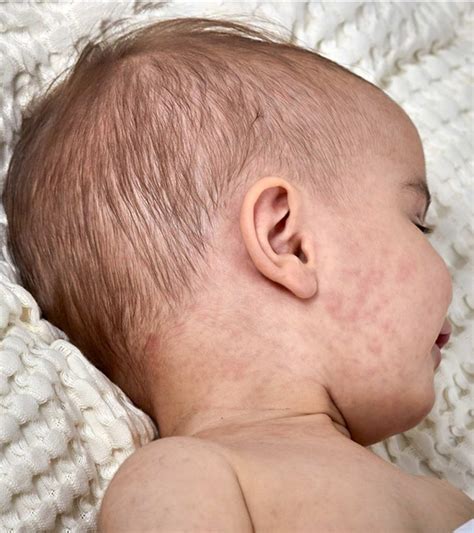 Common Types Of Baby Rashes Causes Treatment Prevention Tips The Best